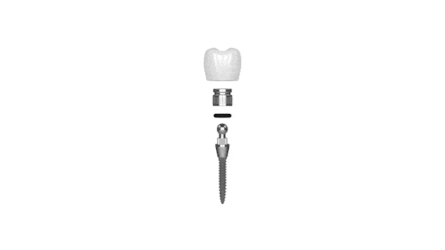 Implantes Dentales en Dallas, TX Bent Tree Dental Dr. Rick Miller