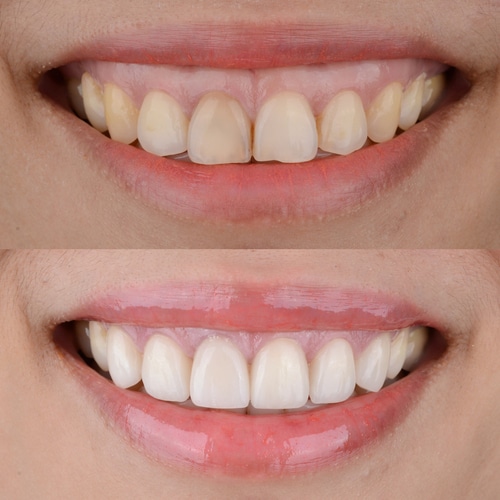 Gum Reshaping for a Balanced Smile in Dallas, TX Dr. Rick Miller