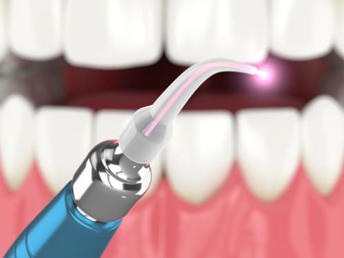 Odontología Láser en Dallas, TX | Terapia Periodontal | Dr. Rick Miller
