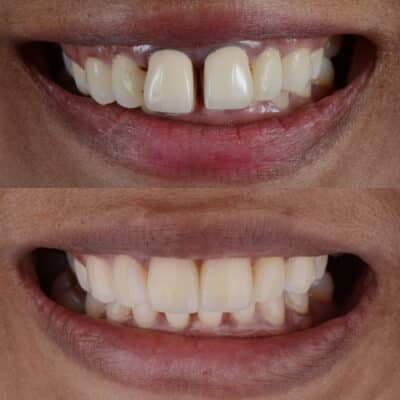 Smile Makeover en Dallas, TX Prostodoncista Bent Tree Dental