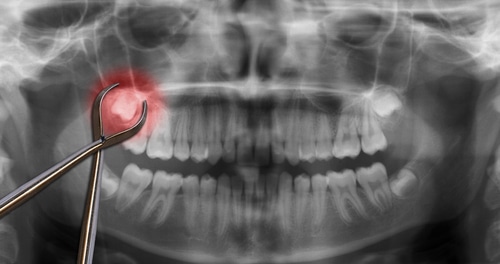 Extracción de dientes en Dallas, TX | Dr. Rick Miller | Bent Tree Dental