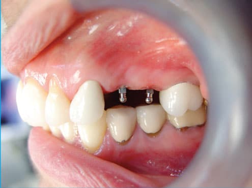 El dentista de implantes de Dallas ofrece una sustitución dental asequible