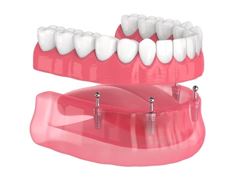 Dentures in Dallas, TX Implant-Retained Dentures Dr. Rick Miller