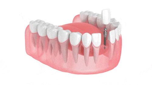 Odontología de implantes en Dallas, TX Recupere su confianza con una solución permanente a la falta de dientes