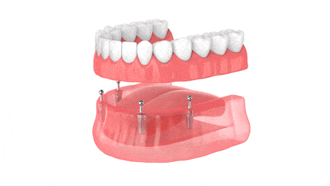 Opciones de Dentadura en Dallas, TX | Dentaduras de Implantes | Dr. Rick Miller