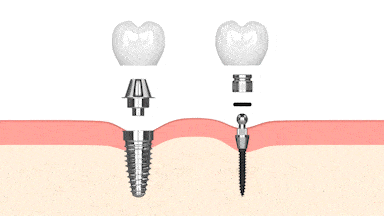Mini Implantes Dentales en Dallas TX Implante Dentista Dr Rick Miller