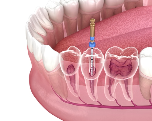 Root Canal Therapy in Dallas, TX  Endodontic Treatment