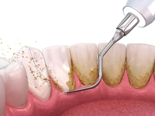 Scaling & Root Planing in Dallas, TX Periodontal Treatment