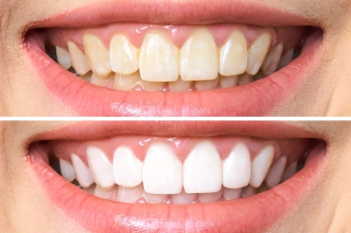 Teeth Whitening in Dallas, TX Teeth Bleaching Dr. Rick Miller