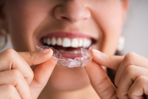 Orthodontics in Dallas, TX Clear Aligners Dr. Rick Miller
