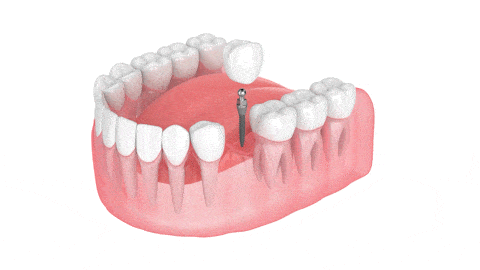 Implantes Dentales en Dallas TX Implantes Dentales Bent Tree Dental