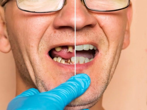 Restorative Dentistry in Dallas TX | Prosthodontist | Dr. Rick Miller