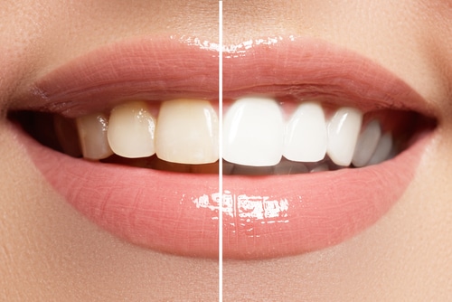 Teeth Whitening in Dallas, TX Dr. Rick Miller Bent Tree Dental