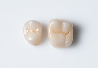 Dental Crowns in Dallas, TX - Dr. Rick Miller