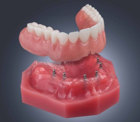 Mini Implant Dentures in Dallas, TX | Denture Options | Dr. Miller