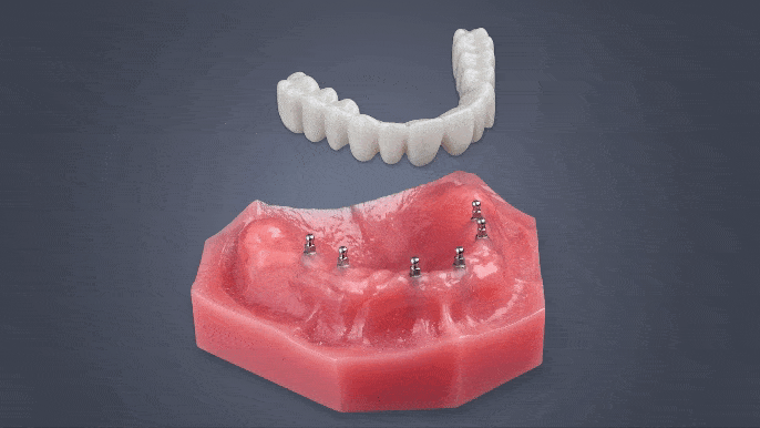 Fix-on-Six en Dallas, TX | Mini Implantes Dentales | Dentaduras Implantadas