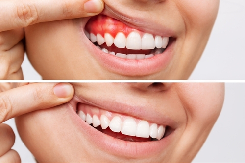 Tratamiento de la enfermedad de las encías en Dallas, TX | Odontología láser | Dolor de dientes