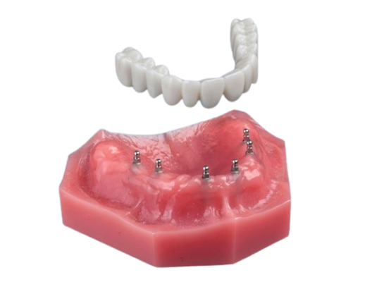 Affordable Dentures in Dallas, TX | Mini Implant | Free Consultation