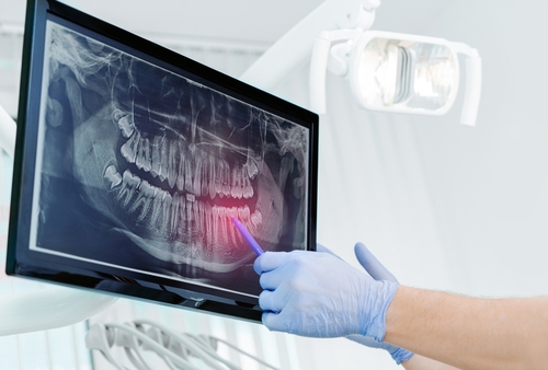 Cirugía Dental | Sedación Odontología en Dallas, TX | Mini Implantes