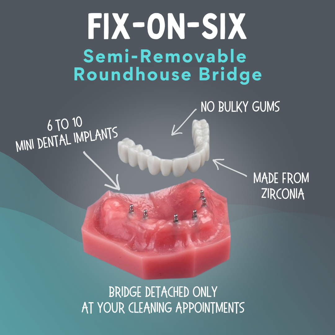 Dentadura fija sobre seis implantes en Dallas, TX