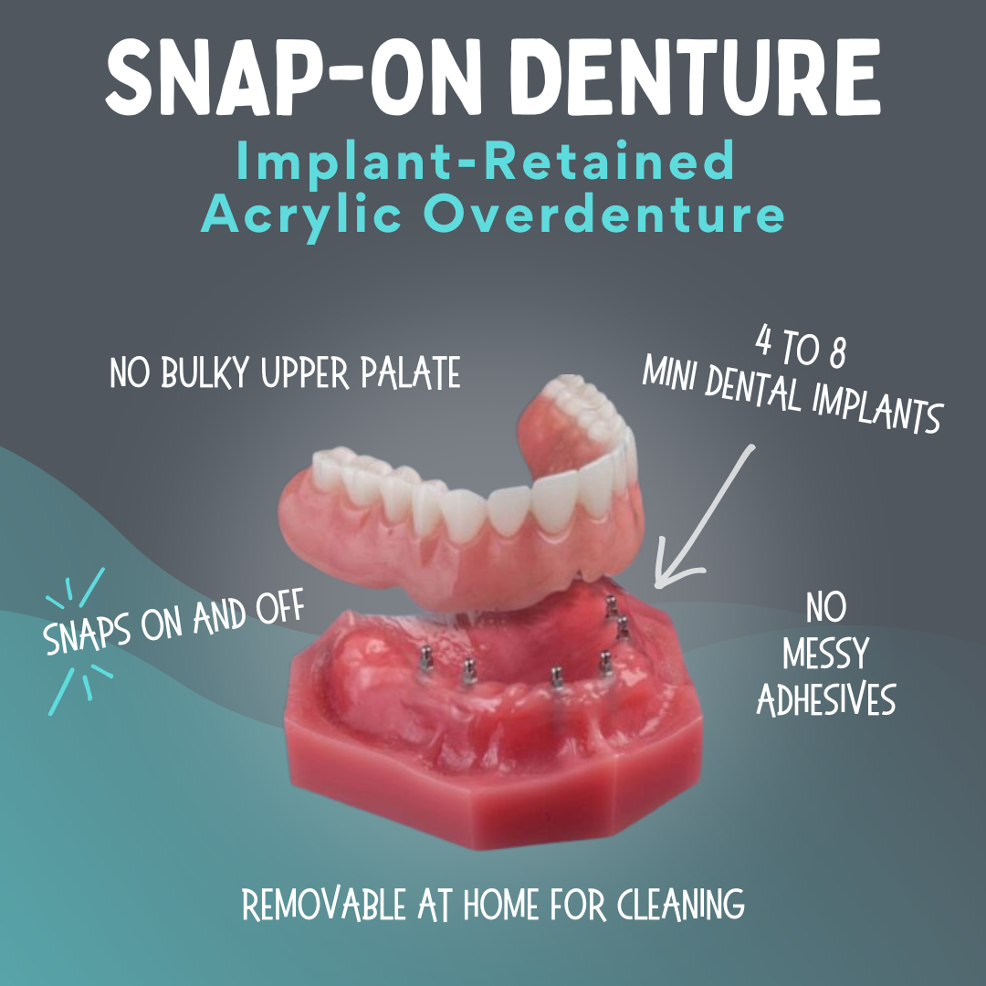 Snap in Dentadura en Dallas, TX