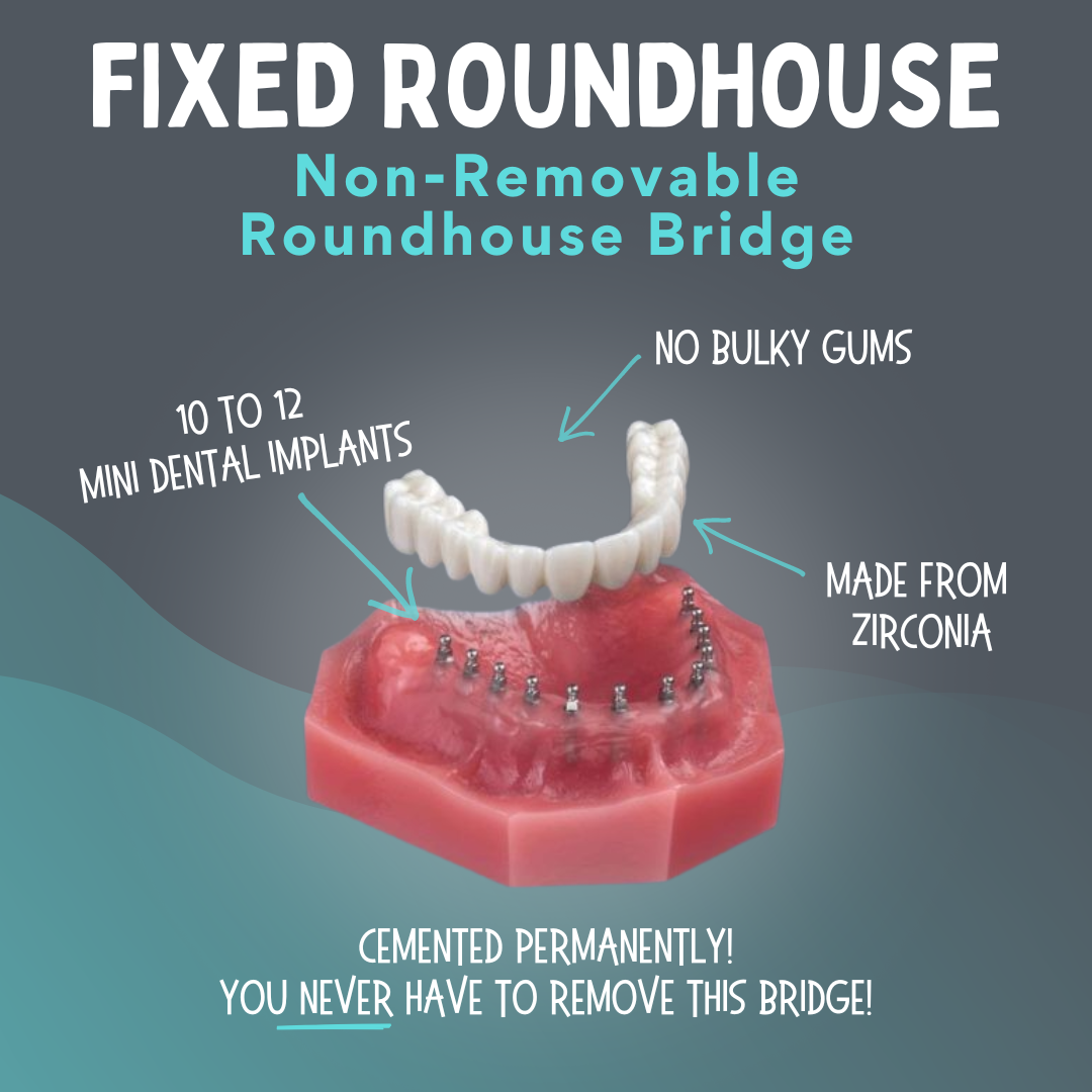 Dentadura fija con implantes permanentes Roundhouse en Dallas, TX