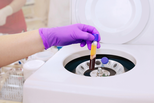 L-PRF Treatment in Dallas, TX | Book a Free Consultation
