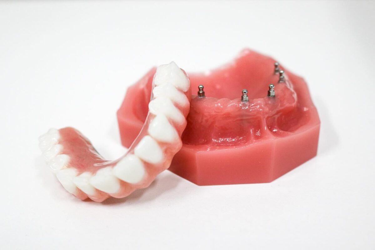 Dentaduras Snap In en Dallas, TX | Reserve una consulta gratuita