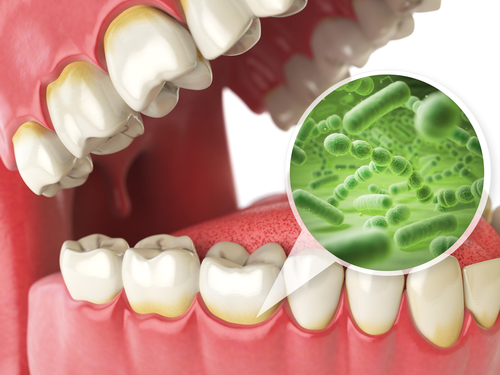Tratamiento de la gingivitis en Dallas, TX | Alivio asequible de la enfermedad de las encías