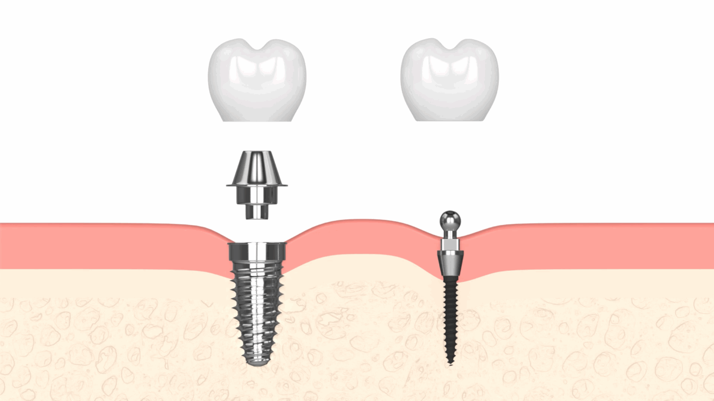 Implantes Dentales Tradicionales vs. Mini Implantes Dentales en Dallas, TX | Consultas Gratuitas