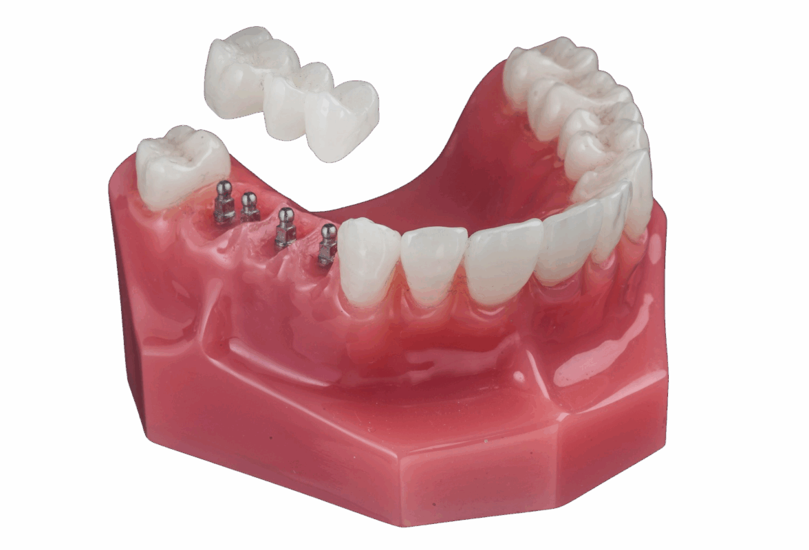 Mini implantes dentales en Plano, Texas | Consultas gratuitas sobre mini implantes