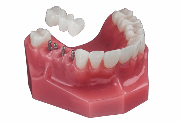 Mini Dental Implants in Plano, TX | Free Mini Implant Consultations