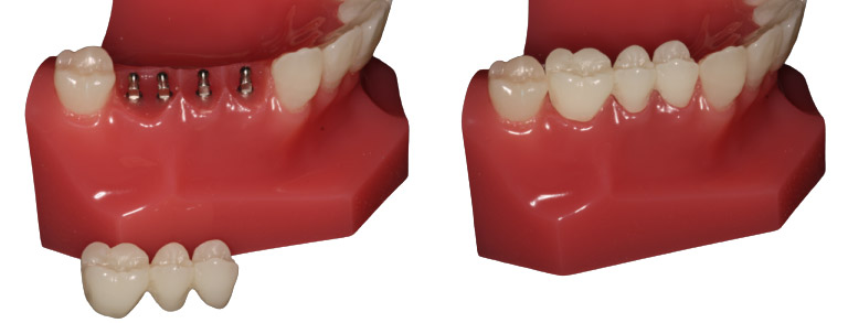 Mini Dental Implants in Carrollton, TX | Free Mini Implant Consults