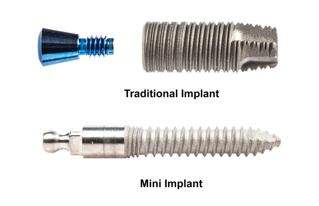 Minimally Invasive Dental Implants in Dallas, TX | Mini Implants